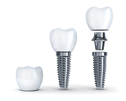 Image of dental implant being assembled, at Solutions Dental Implants in Sun City West, AZ.