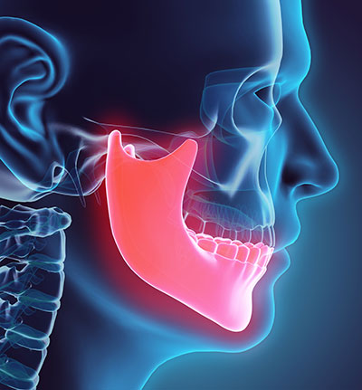 Rendering of a jawbone effected by progressive bone loss in need of treatment from Solutions Dental Implants in Sun City West, AZ