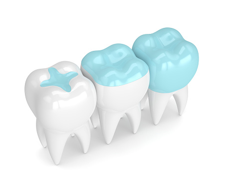 3D rendering of three teeth, one each with an inlay, onlay, and dental crown.