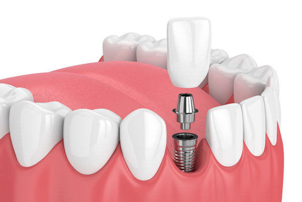 Diagram of dental implant at Solutions Dental Implants in Sun City West, AZ Diagram of dental implant at Solutions Dental Implants in Sun City West, AZ