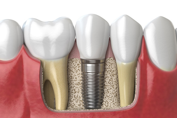 3D rendering of a dental implant next to healthy teeth at Solutions Dental Implants in Sun City West, AZ.