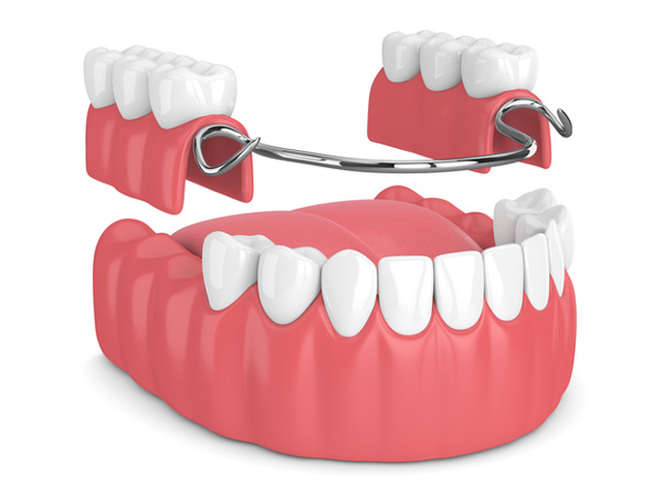 Rendering of removable partial denture at Solutions Dental Implants in Sun City West, AZ