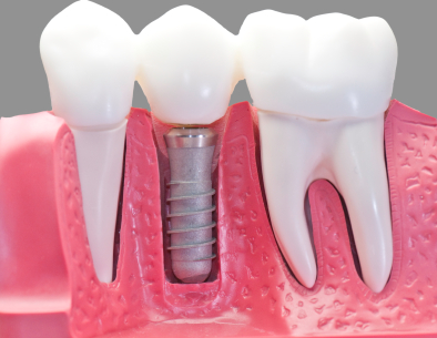 Plastic model of a dental implant screw and crown at Solutions Dental Implants in Sun City West, AZ