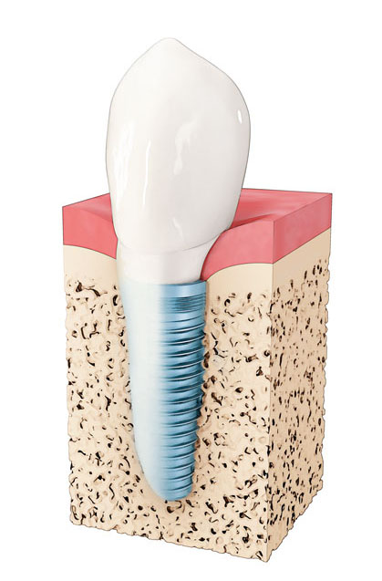 Diagram of a dental implant at Solutions Dental Implants in Sun City West, AZ Diagram of a dental implant at Solutions Dental Implants in Sun City West, AZ