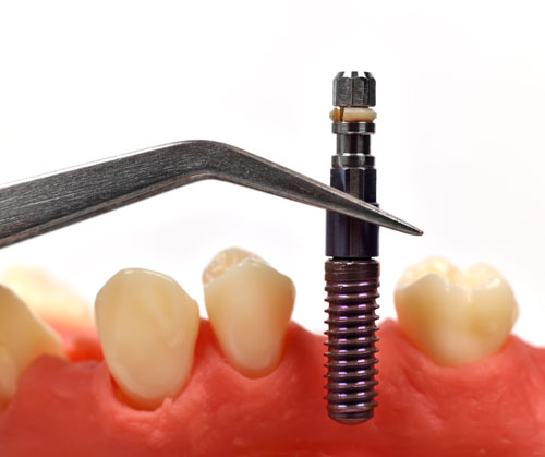 an implant stability quotient meter being used at Solutions Dental Implants 