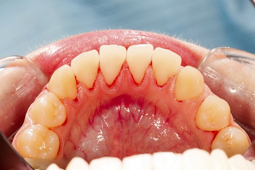 a patient in need of gum tissue regeneration from Solutions Dental Implants 