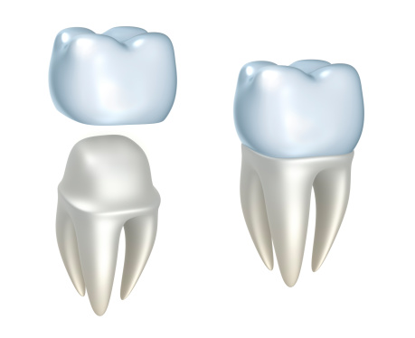 Model of Dental Crown from Solutions Dental Implants in Sun City West, AZ Model of Dental Crown from Solutions Dental Implants in Sun City West, AZ